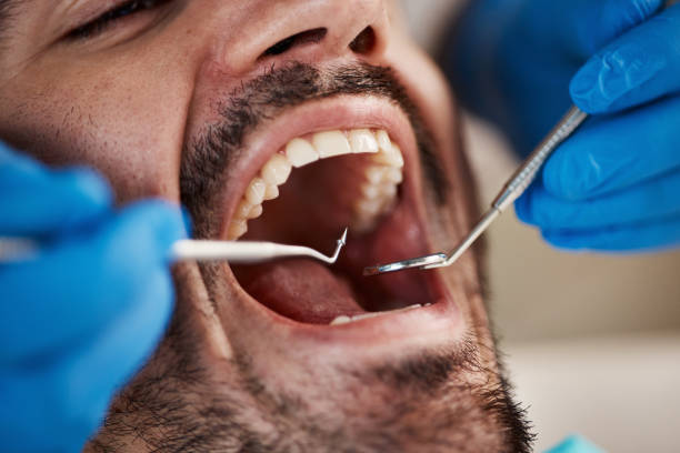 Best Knocked-Out Tooth (Avulsed Tooth) Treatment in Bloomgton, IN