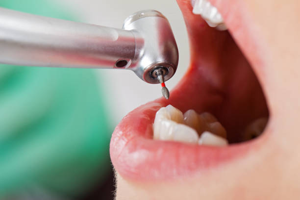 Best Emergency Root Canal Therapy in Bloomgton, IN